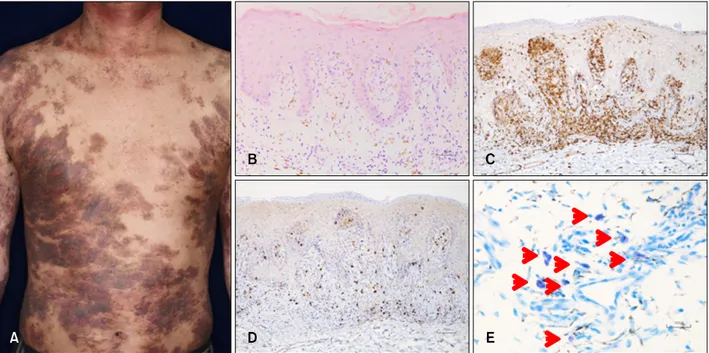 Fig. 1. (A) Clinical manifestation. Hyperpigmented plaques on the trunk. (B) Histology of the lesional skin of a hyperpigmented plaque