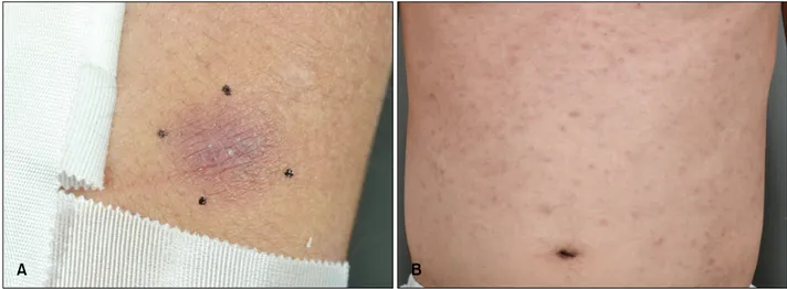 Fig. 1. (A) A 2×2-cm-sized hyperpigmented nodule on the left arm. (B) Multiple miliary grain to rice-grain-sized erythematous to  brownish macules and papules on the trunk.