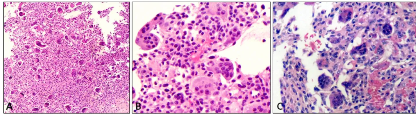 Fig. 2. (A) Hypercellular stroma composed of mononuclear tumor cells and many multinucleated giant cells (H&amp;E, ×40)