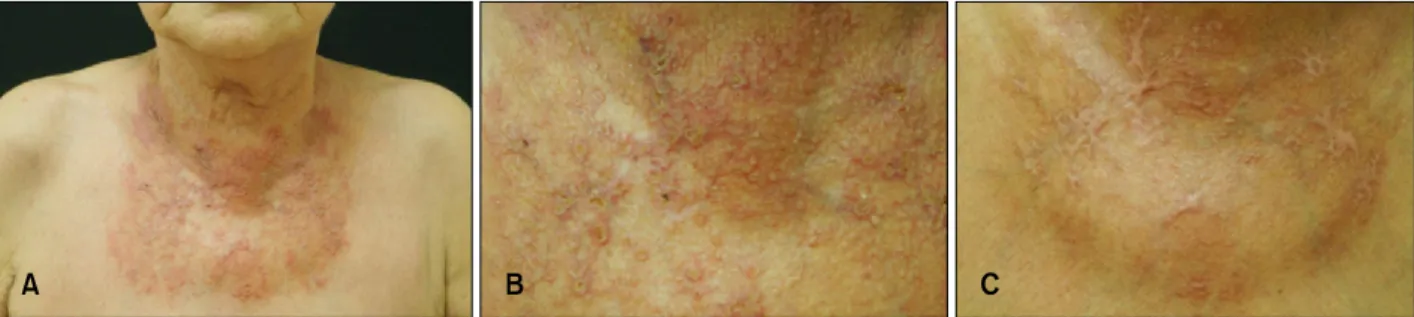 Fig. 1. (A) Several crusted papules on an erythematous telangiectactic patch on the anterior neck and upper chest