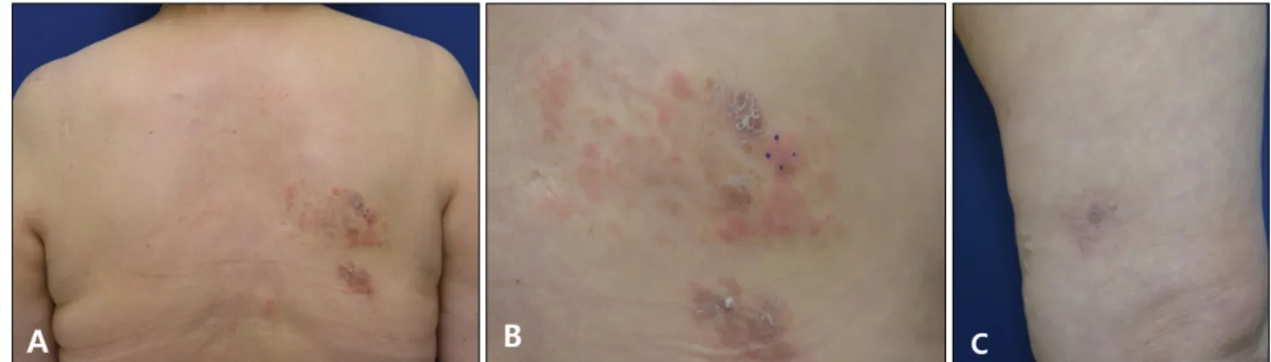Fig. 1. Erythematous papules and plaques with areas of brownish hyperpigmentation on (A), (B) right upper back and (C) left thigh.