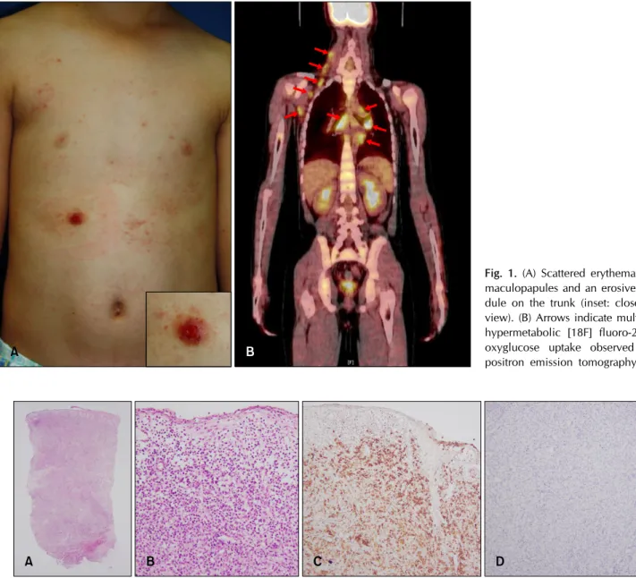 Fig. 2. (A) A skin biopsy specimen from the erosive nodule showed epidermal erosion and diffuse dermal cellular infiltration (H&amp;E, 