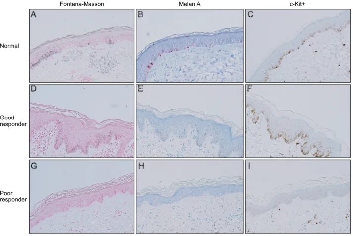 Fig. 2. Immunohistochemical staining for Fontana-Masson, Melan A, and c-kit+ (CD117) in sections of normal skin epidermis (A∼C),  good responder vitiligo lesions (D∼F), and poor responder vitiligo lesion (G∼I)