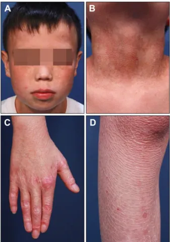 Fig. 1. Clinical features of the patient. (A, B) Poikiloderma on  the face and neck. (C) Atrophic change on the dorsal aspect of  hand