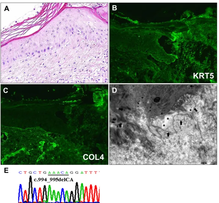 Fig. 2. (A) Histological examination. Hyperkeratosis and epidermal atrophy (H&amp;E, ×400)