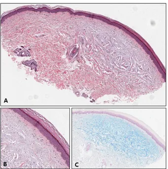 Fig. 2. (A) Left dorsum of hand and  anterior chest before treatment. (B)  Left dorsum of hand and anterior  chest after 15 weeks of tacrolimus  ointment 0.1% application.