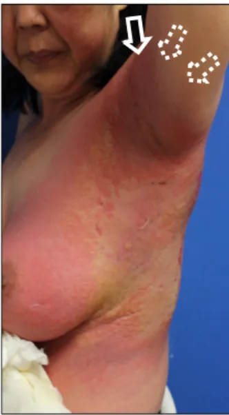 Fig. 2. Severe papillary dermal edema and superficial perivenular  mixed inflammatory cell infiltrates with an increased number of  eosinophils (H&amp;E, ×100; inset, ×400)