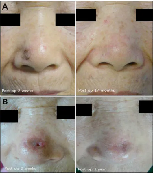 Fig. 1. Clinical images of skin graft  scar. (A) A 73-year-old woman who  underwent skin graft because of  basal cell carcinoma on the ala of  nose