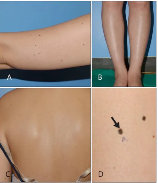 Fig. 1. (A) Multiple melanocytic  nevi scattered on the left upper  arm, (B) both lower legs, and (C)  on the back