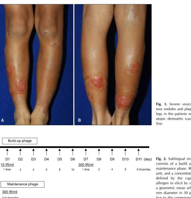 Fig. 1. Severe vesicular eczema- eczema-tous nodules and plaques on lower  legs in the patients with refractory  atopic dermatitis (case 1) at  base-line.