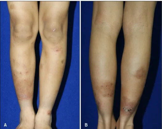 Fig. 3. After 12 months with sub- sub-lingual immunotherapy, marked  improved lesions on both lower leg  with brownish patch and crust.