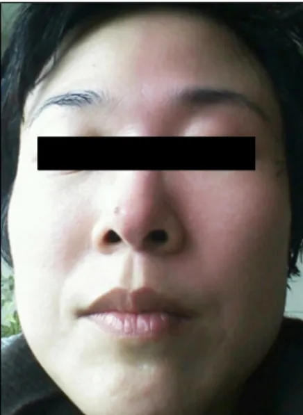Fig. 1. She experienced flushing on the left side of her face  following physical exercise.