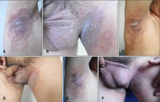 Fig. 1. (A, B) Erythema and erosions in the axillary area and inguinal area. (C, D) The clinical situation after three treatments of  aminolevulinic acid photodynamic therapy (ALA-PDT) therapy every 2 wk