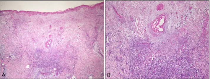 Fig. 2. Histopathologic finding showing a wedge-shaped dermal infarct with a broad base toward the epidermis