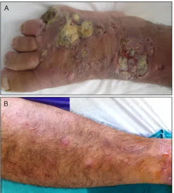 Fig. 3. Dermal infiltration of atypical squamous cells (H&amp;E, ×100).