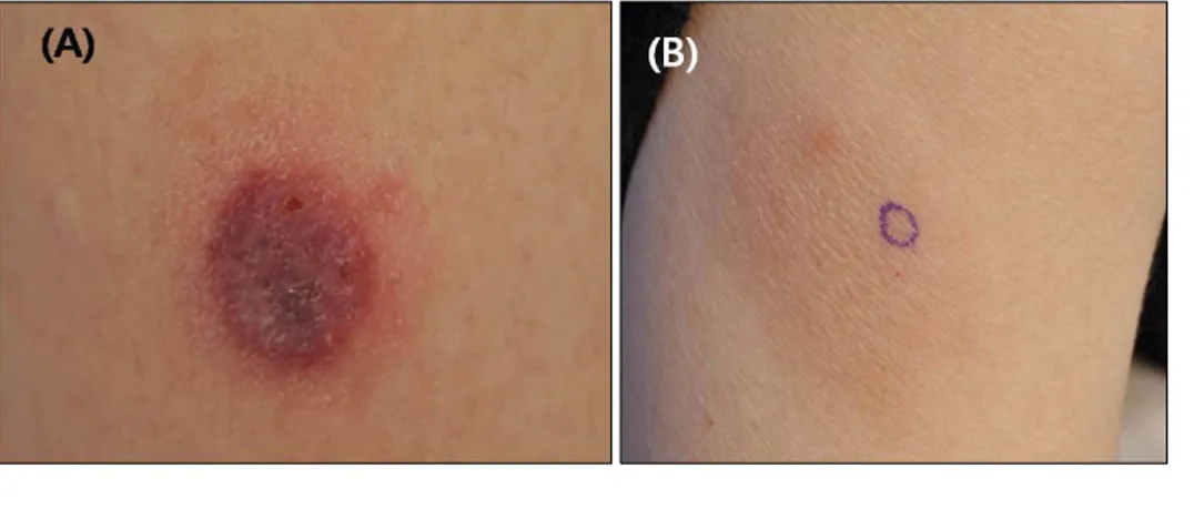 Fig. 1. Clinical manifestation of the  skin lesions. (A) A tender dark  ery-thematous scaly indurated plaque  with oozing on the right thigh