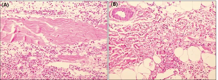 Fig. 2. (A) The marked infiltrates composed of numerous eosinophis with a slight admixture of lymphocytes in the perimysium (H&amp;E, 