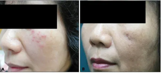 Fig. 1. (A) Multiple, erythematous,  various sized, scaly papules on the  left cheek. (B) After 4 months, the  lesions improved with  postinflam-matory hyperpigmentation and  atro-phic scar.