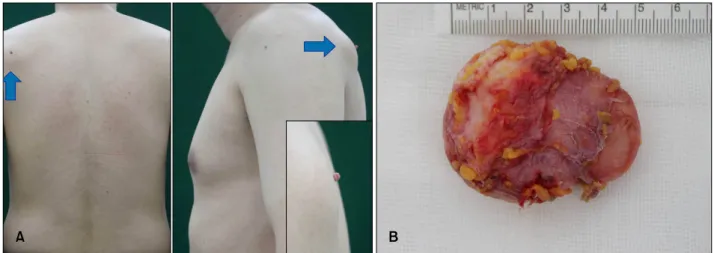 Fig. 2. (A) Scanning view of the histopathological examination of the lesion showing an encapsulated mass located from the lower  dermis through the subcutaneous tissue with a central cavity
