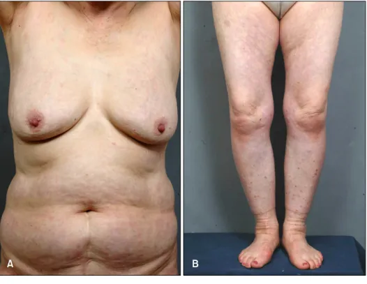 Fig. 1. Multiple erythematous ma- ma-cules and patches were observed on  her trunk (A) and both extremities  (B).