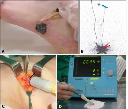 Fig 1. Lymphoscintigraphy-guided sen- sen-tinel lymph node (SLN) biopsy. (A)  Intradermal injection of radioactive  tra-cer (technetium-99m) around the  pri-mary tumor