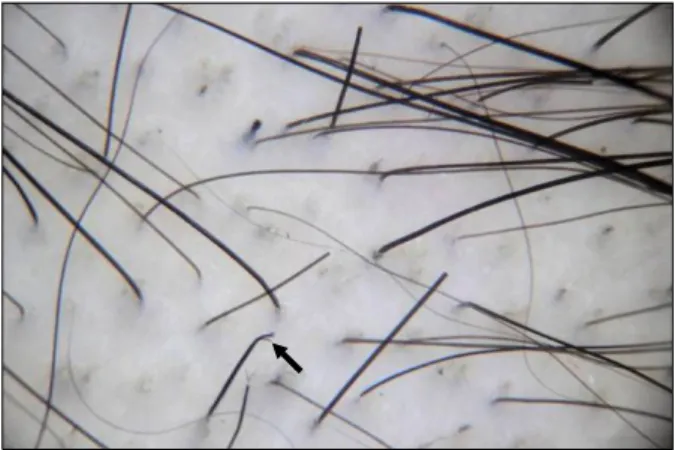 Fig. 2. Dermoscopic features of trichotillomania; broken hairs  and characteristic split end (arrow).