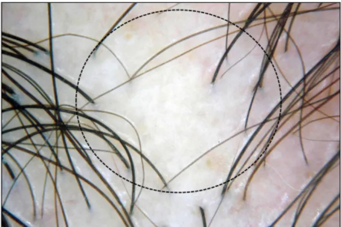 Fig. 8. Dermoscopic features of pseudopelade of Brocq; lack of  follicular ostia (dotted circle) without otherspecific finding.