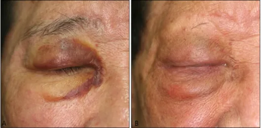 Fig. 1. Clinical photographs of re- re-current angiosarcoma on the right  eyelid. (A) Initial presentation