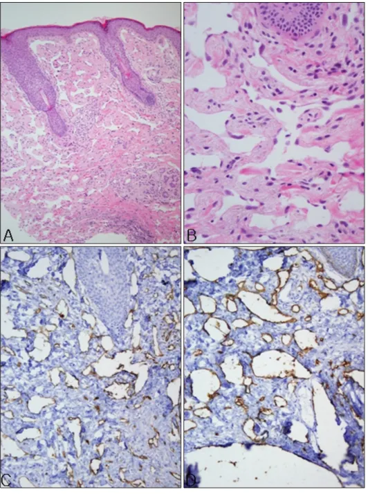 Fig. 2. Histopathological findings of the lesion before radiotherapy. (A, B) Numerous irregular anastomosing  vascular channels lined by a single  layer of enlarged atypical endothelial  cells dissecting collagen bundles in  the dermis (A: H&amp;E, ×40; B: