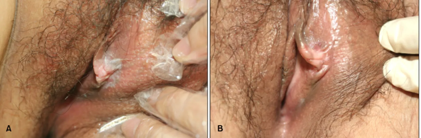 Fig. 1. (A) Erosive patches and verrucous papules with a pinkish center and a black-pigmented margin on the left labium minor.