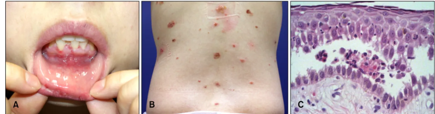 Fig. 2. Polymerase chain reaction results show a positive band on 189 bp. M: 100 bp DNA ladder, Lane 1: positive result of the  patient’s tissue for herpes simplex type 1 virus (189 bp), Lane 2: 