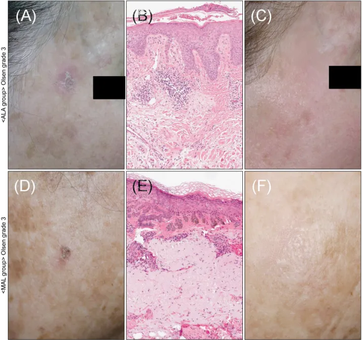Fig. 3. Clinical and histopathological images of the representative cases treated for Olsen grade 3 (severe) actinic keratosis with  5-aminolevulinic acid photodynamic therapy (ALA-PDT) (A∼C) and methyl aminolevulinate (MAL)-PDT (D∼F)