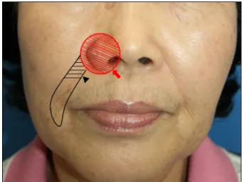 Fig. 1. Preoperative view. A 1.0×1.5 cm nodule on the right  lateral ala.