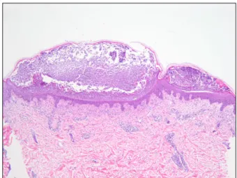 Fig. 1. Multiple nonfollicular pustules with surround erythema  on the trunk.