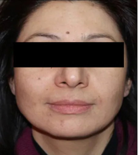 Fig. 2. Significant regression in epidermal hyperpigmentation.
