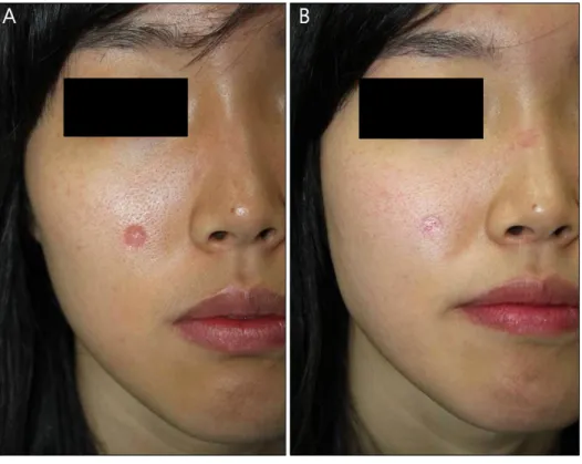 Fig. 1. (A) Post-laser depressed scar  on the face. (B) Marked  improve-ment after 8 sessions.