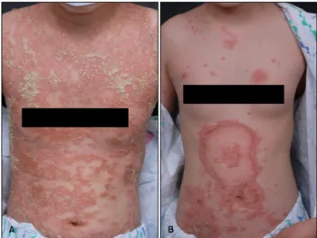 Fig. 1. More extensive and aggressive pustular patches (A)  covering  ＞90% of the body surface area compared to those  observed in the previous attack (B).