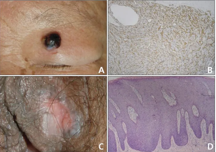 Fig. 2. Various malignant and premalignant cutaneous lesions mimicking basal cell carcinoma