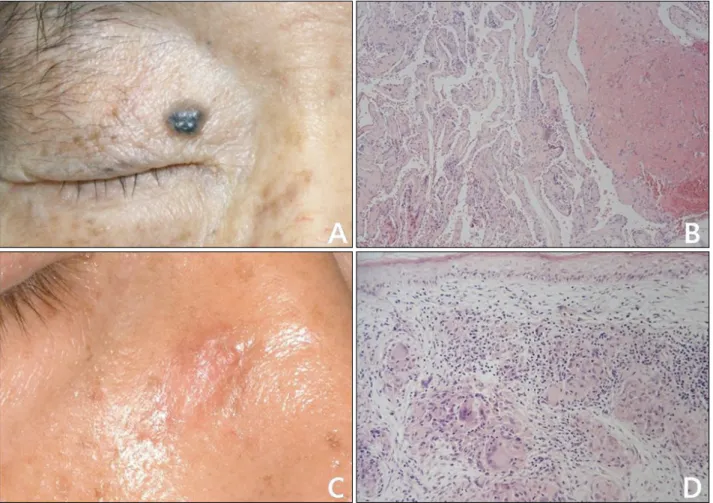 Fig. 3. Various benign cutaneous lesions mimicking basal cell carcinoma (A, B) Intravascular papillary endothelial hyperplasia
