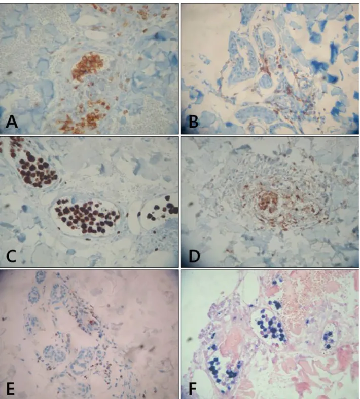 Fig. 3. The neoplastic cells are positive for CD3 (A, ×400), CD8 (B, ×200), Ki-67 (C, ×400), MPO (D, ×200), and granzyme B (E, ×200)