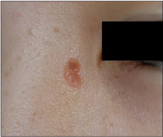 Fig. 1. A yellowish, bean-sized, verrucous plaque on the left me- me-dial canthus, and multiple, scattered, pea-sized, hyperpigmented  macules on the face.