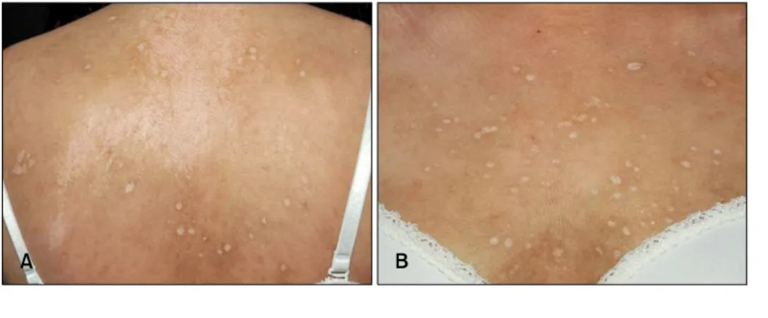 Fig. 1. Multiple widespread atro- atro-phic whitish lesions on the upper  back (A) and chest (B).