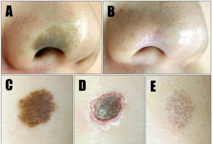 Fig. 1. Congenital melanocytic nevus (CMN) in a 25-year-old man. (A) Before treatment: a solitary, 1-cm brown patch is visible on  the right alar area of the nose