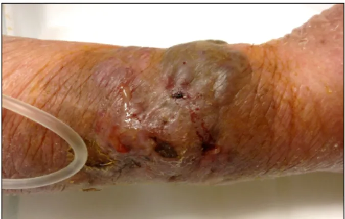 Fig. 1. Erythematous eschar-like crusted indurated plaque and  pustules with purulent discharges on the right forearm.