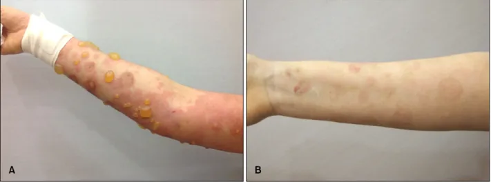 Fig. 1. (A) Large tense bullae and erythematous pruritic plaques on the arm. (B) Improved skin lesions with postinflammatory hyper- hyper-pigmentation after intravenous immunoglobulin combination treatment.