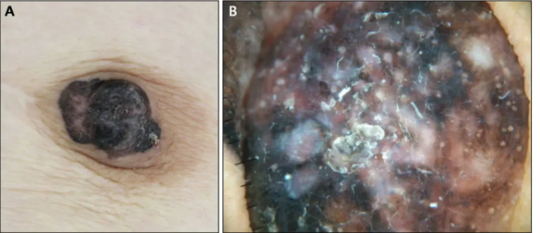 Fig. 1. Clinical and dermoscopic  features of pigmented mammary  Paget disease. (A) Well-demarcated  dark brown plaque on the nipple