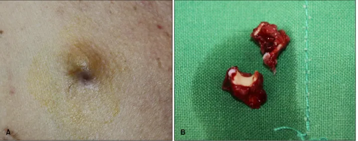 Fig. 1. (A) A solitary, 2 cm-sized, firm, skin-colored subcutaneous mass on the right chest