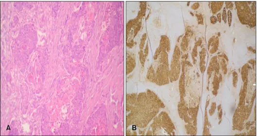 Fig. 1. (A) Poorly differentiated pri- pri-mary adenocarcinoma in excised  gallbladder tissue (H&amp;E, ×200)