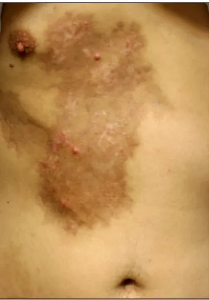 Fig. 1. Two, asymptomatic, erythematous papules and underlying pigmentation and wood plate-like induration on the right chest.
