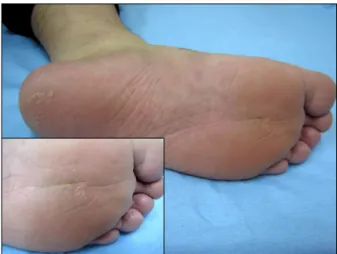 Fig. 2. Six weeks later following biopsy, the wart had completely disappeared (inset: close-up view).